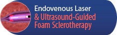 Endovenous laser & Ultrasound-Guided Foam Sclerotherapy - Kuring-Gai Vascular Ultrasound